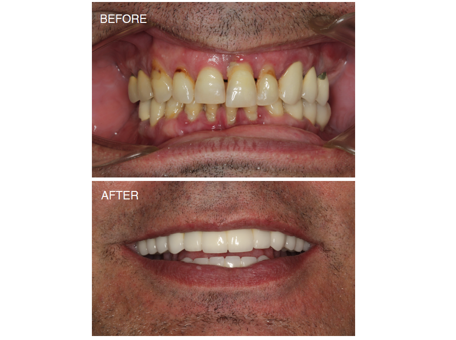 Dental Implant reconstruction case