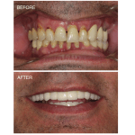 Dental Implant reconstruction case