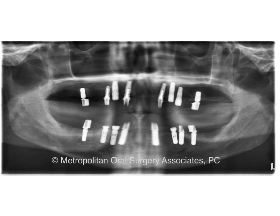 Dental Implant reconstruction case