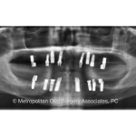 Dental Implant reconstruction case