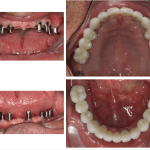 Dental Implant reconstruction case