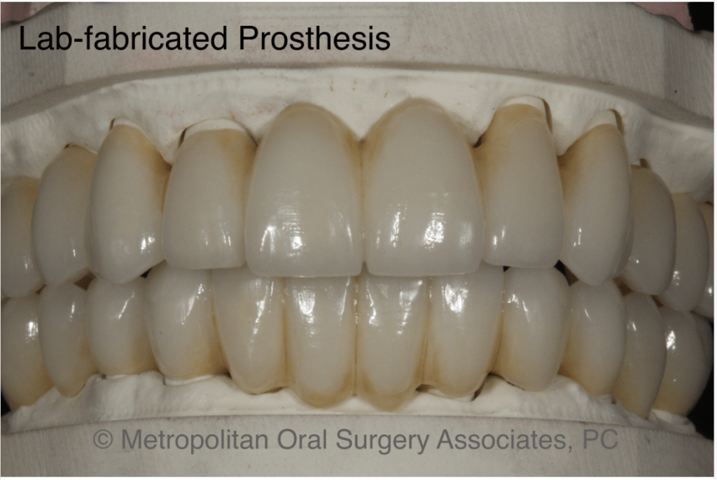 Dental Implant reconstruction case
