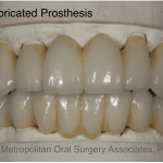 Dental Implant reconstruction case